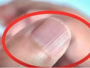 绿巨人成人网址廠家分析手指甲有豎紋的根本原因 绿巨人成人网址廠家分析手指甲有豎紋的根本原因
