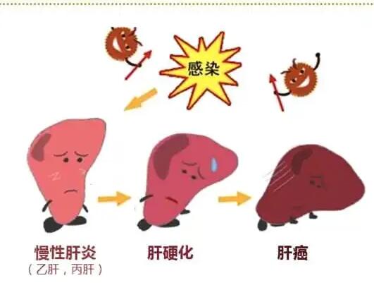 绿巨人视频污APP廠家提醒肝髒疾病治不好？要了解是否含鐵食物攝入多